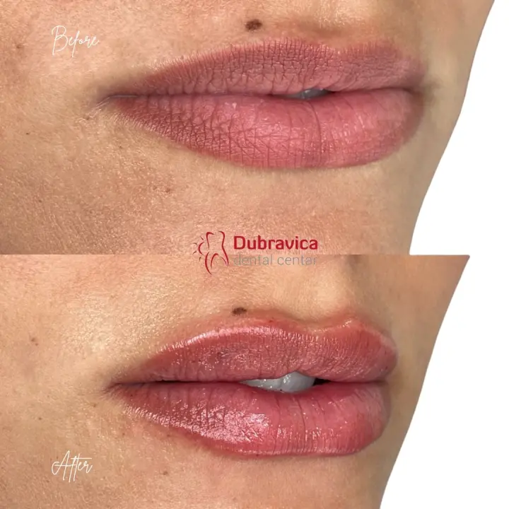 FOTO Dan žena u Dubravici: Iskoristite popust na najnovije trendove u estetskoj medicini 